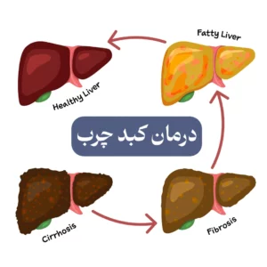 درمان کبدچرب-سوپرفود ان بی اس